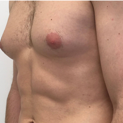 Discover the Confidence Boost: A Simple Guide to Breast Implants in Dubai