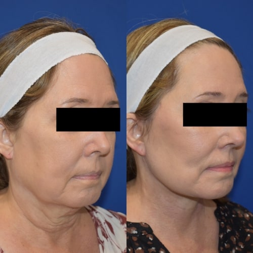 Turn Back Time: Why a Neck Lift in Dubai Is the Secret to a Youthful Look