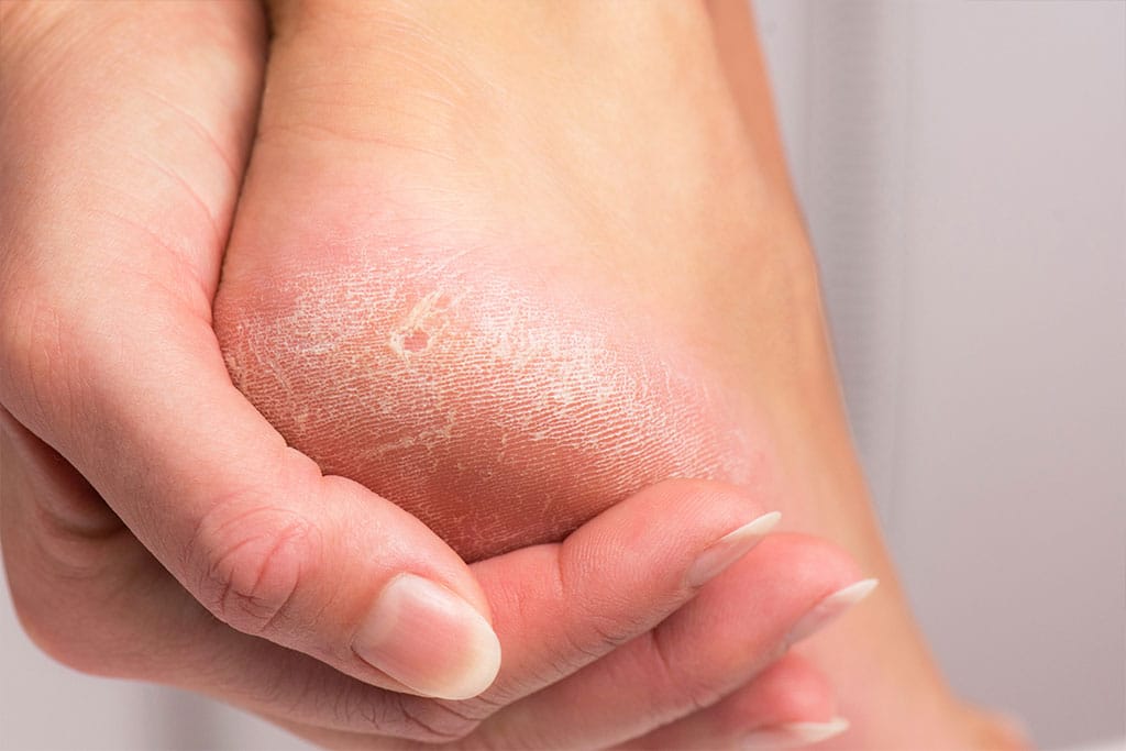 Cracked Heel Skin: Restore Moisture and Reduce Friction